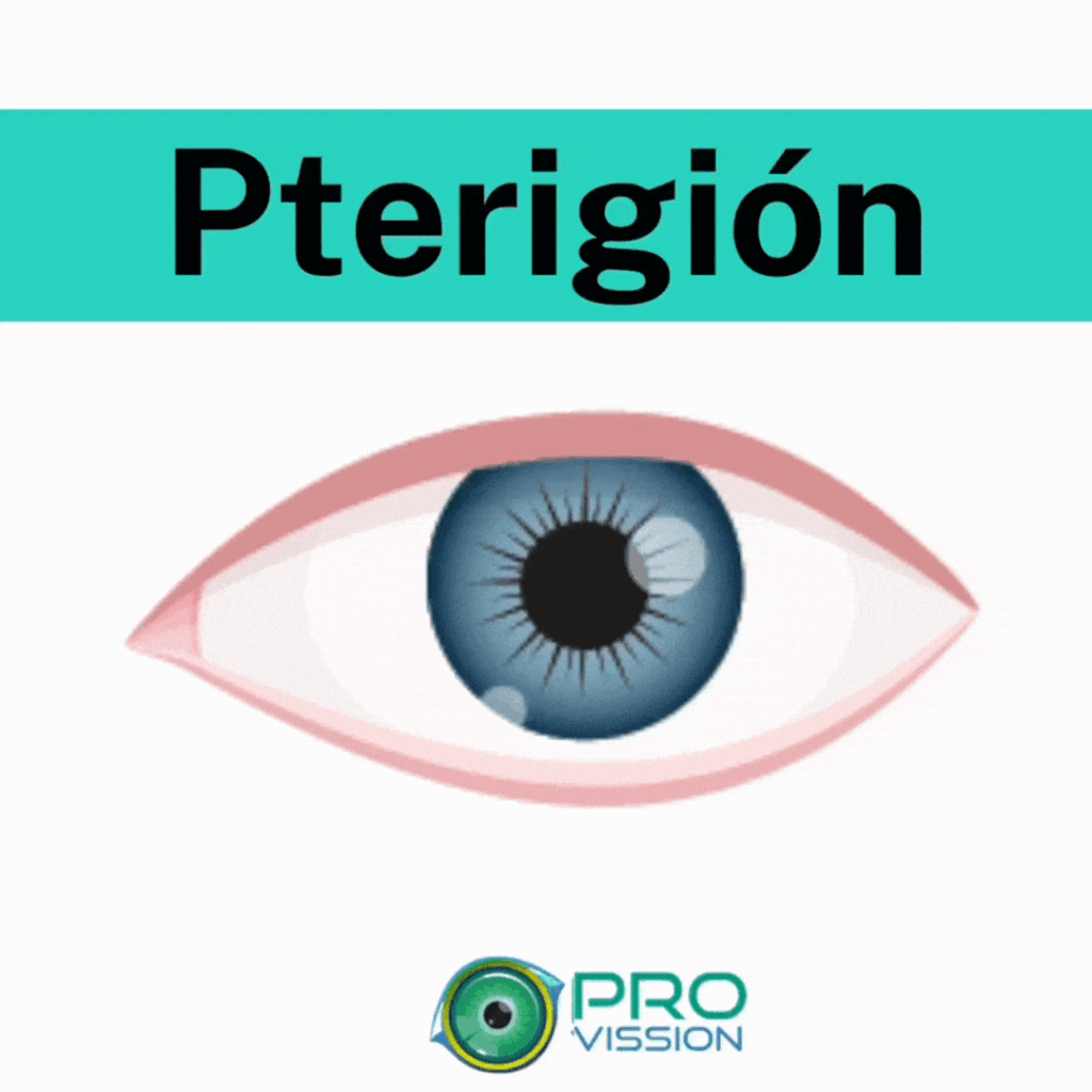 animated gif pterigion graphic explainer 3 seconds