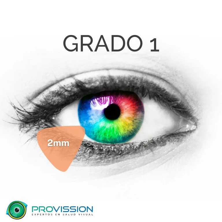 Pterigión-Grados-Provission-Cancun