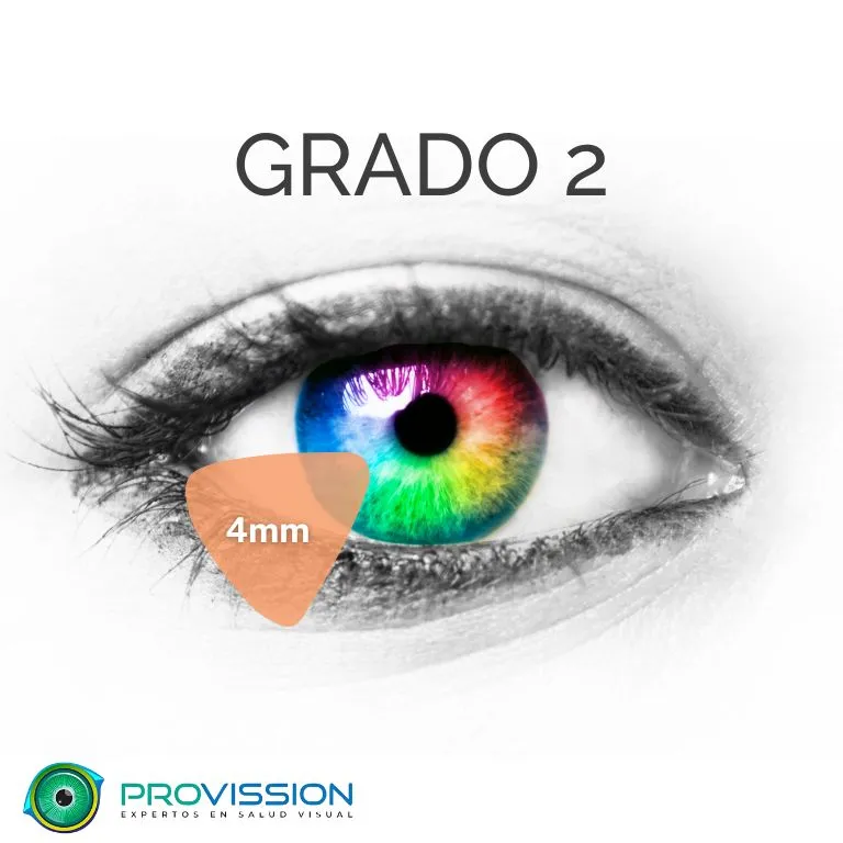 Pterigión-Grados-Provission-Cancun