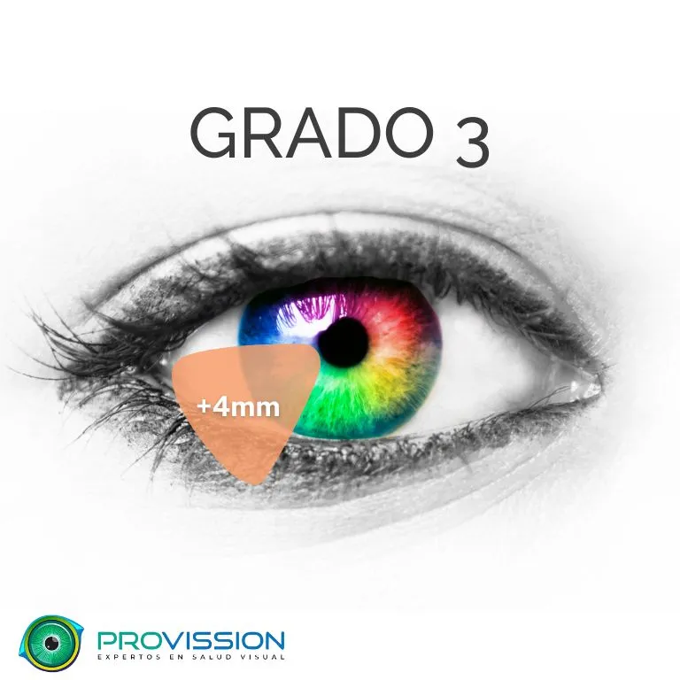 Pterigión-Grados-Provission-Cancun