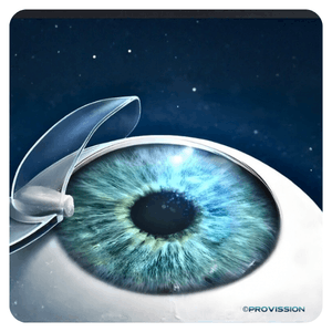 LASIK Cancun – Creación del flap corneal con láser en PROVISSIÓN