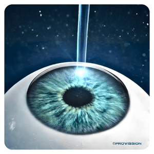 LASIK Cancun – Remodelación corneal con láser excímer en PROVISSIÓN