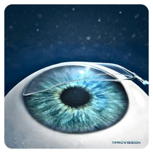 LASIK Cancun – Reposición del flap corneal en PROVISSIÓN